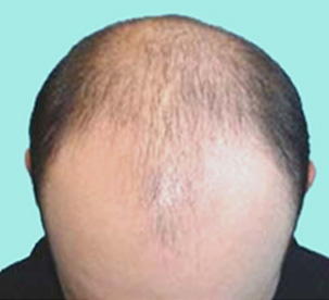 baldness treatment clinic